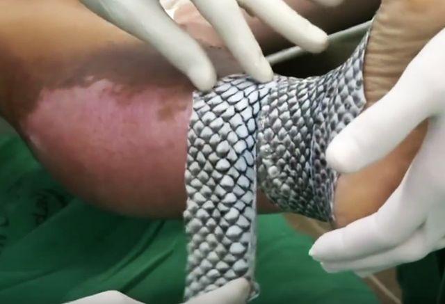 Brazilski lekari pronašli odlièan naèin za leèenje opekotina